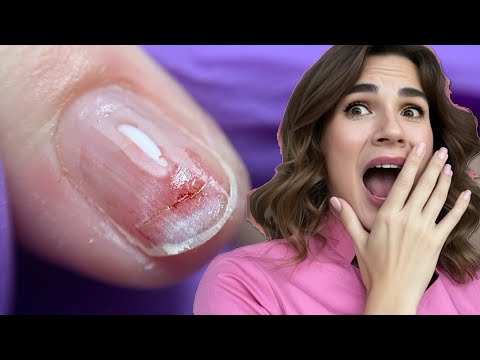From Bad to Worse: Bitten Nails Extensions Gone Wrong 😭