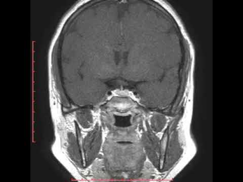 Nausea dal dolore alle articolazioni Fisioterapia nella gonartrosi del ginocchio efficace o inutile