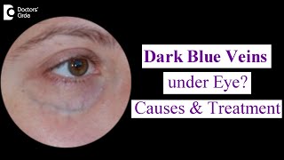 Veins Under Eyes (Dark Blue Veins under EYE) : Causes & Treatment - Dr. Nischal K  | Doctors