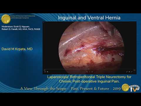 Neurectomía triple retroperitoneal laparoscópica para el dolor inguinal posoperatorio crónico