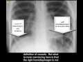 Chest x-ray , pneumonia 