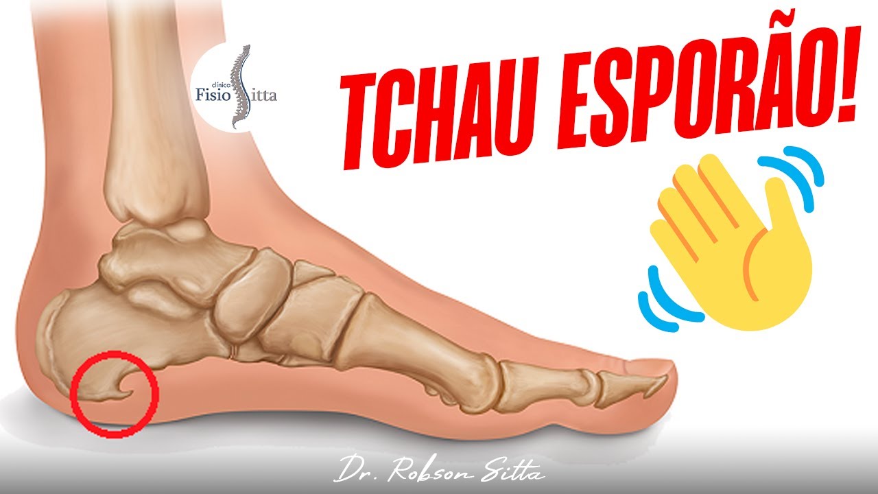 ESPORÃO CALCÂNEO - TRATAMENTO CASEIRO COM 4 EXERCÍCIOS Dr. Robson Sitta