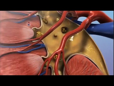 Calcul rénal (animation 3D)