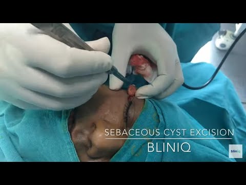Patient Recovery Case — Video 28 (Liposuction)