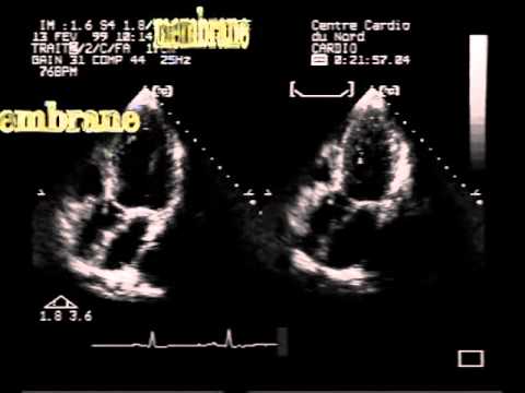 Subaortic Membrane And Mild Aortic Regurgitation