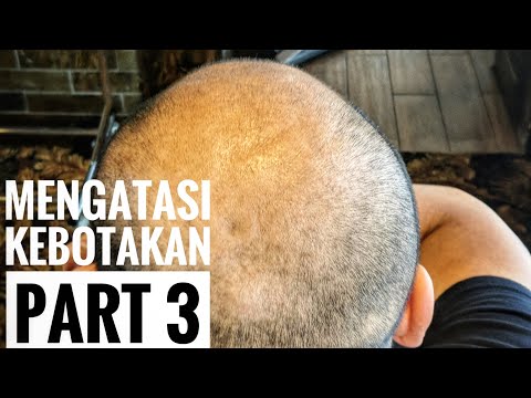 MENGATASI kebotakan FAST RESULT!! |Kenji Mozaro
