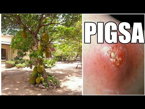 Pasalingsing kuko paggamot metro proletaryong Mga bawal na gamot para sa paggamot ng tainga halamang-singaw