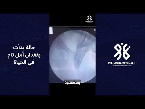 المريض كان رافض الأكل، وحالته النفسية سيئة جدًا بسبب معاناة طويلة مع قسطرة فوق العانة