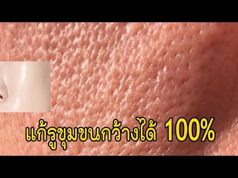 เพิ่ม Macrolane เต้านม เต้านมเทียมใส่