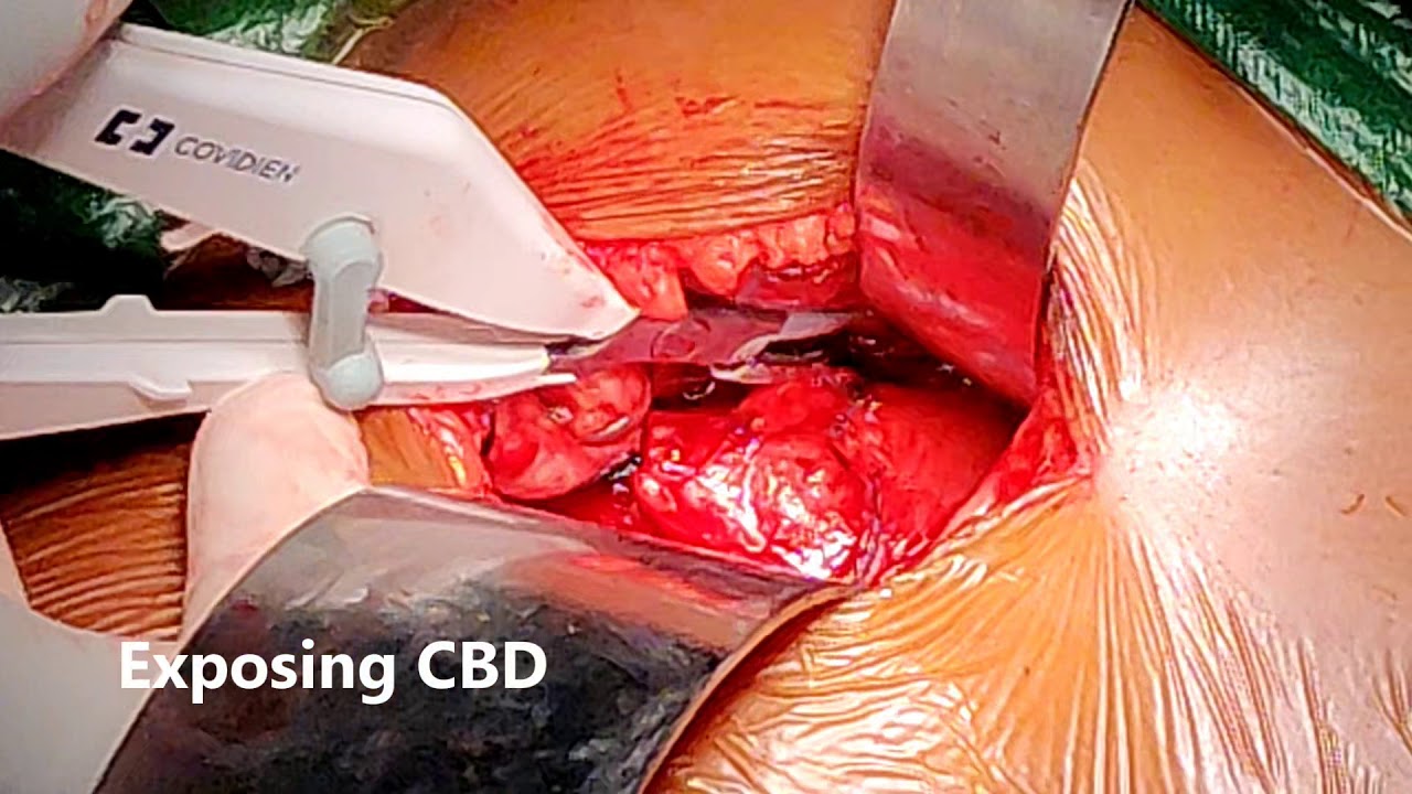 CBD Stone T-Tube