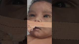 Seizure continues abnormal moments #ventilador support #birthAshpyxia #shortvideo #viralvideo #baby