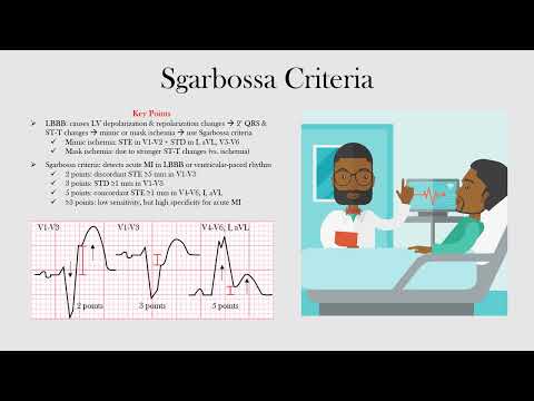 Sgarbossa Criteria
