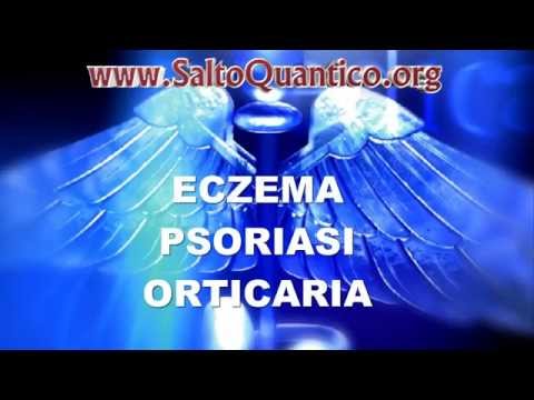 Cura di dermatite di atopic tentorium Eczema di trattamento per bambini