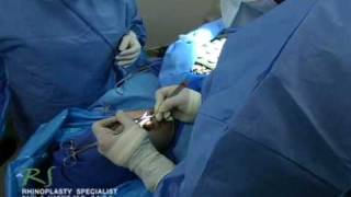 OR Video Footage: Nose Job for Deviated Septum