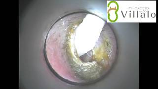 耳掃除動画vol.44「4回目の登場 今回も大漁です」