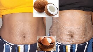 REMOVE your STRETCH MARKS in 3days😱 with just this remedy