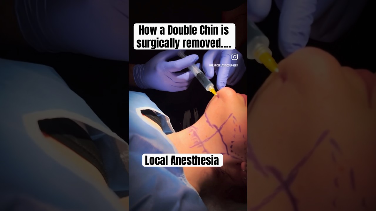 How to get rid of a double chin|| Austin Chin Lipo