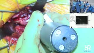 Dr. Stefan Kreuzer performs Total Hip Arthroplasty using @IntellijointSurgical  (Anterior Approach)