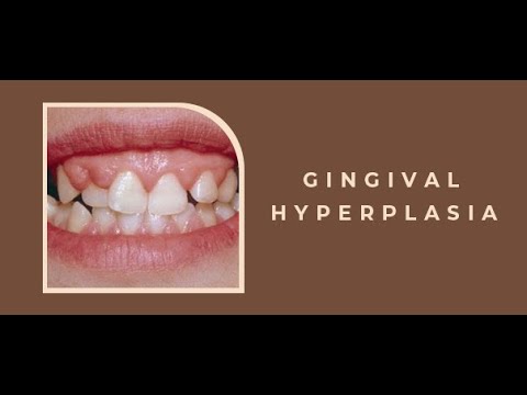 Gingival hyperplasia Or gingival overgrowth or gum enlargement, Hypertrophy ; Causes, Symptoms,