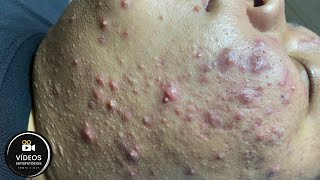 Muito Satisfatório | Remoção de cravos e espinhas 😱