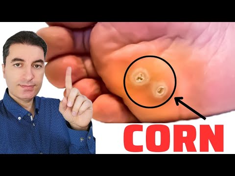 Kako ukloniti KURJE OČI za 24 SATA?