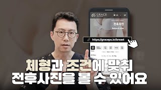 [가슴성형] 나와 비슷한 체형의 수술 결과를 홈페이지에서 쉽게 볼 수 있어요!