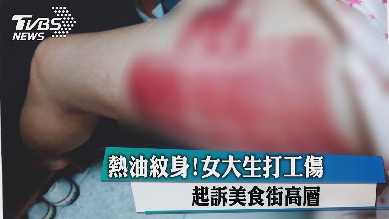 熱油紋身！女大生打工傷　起訴美食街高層