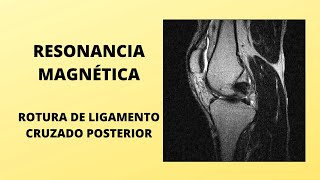 Lesión del ligamento cruzado posterior ¿Cómo se ve en resonancia magnética