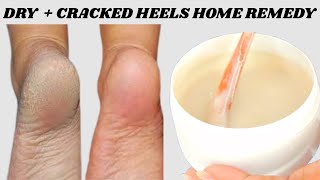 HOW I GOT RID OF DRY CRACKED FEET+ HEELS NATURALLY | AT HOME REMEDY FOR DRY FEET