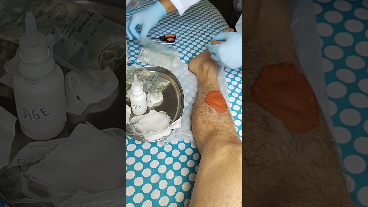 Watch Now Troca de curativo de tecido de granulação. Troca de curativo de tecido de granulação.