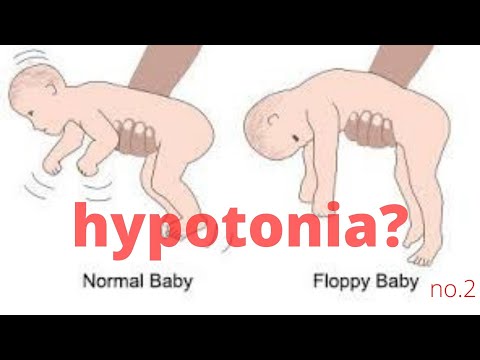 Hypotonia & quadriplegia part 2/How you can facilitate normal motor patterns