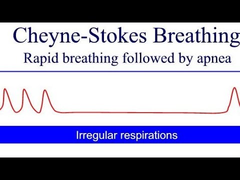 Cheyne Stokes Breathing Pattern | general diseases in human body (Cheyne Stokes, Kussmaul's, Biot's)