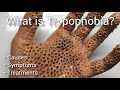 What is Trypophobia? Causes and Treatments Holy Holes Kendall Jenner's Fear