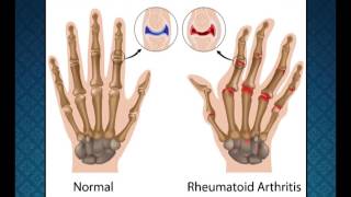 World Arthritis Day- Health Tips by Dr.MIMS - Malayalam Animation Series