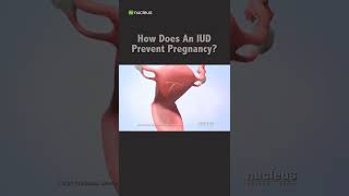 How Does An IUD Prevent Pregnancy? #shorts