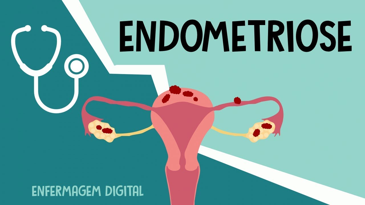 Endometriose - Manifestações clínicas, diagnóstico e Tratamento