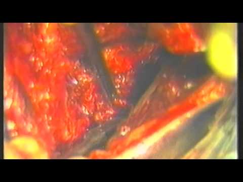 Dolore al ginocchio quando si cammina gonfiore La sconfitta delle radici del rachide cervicale