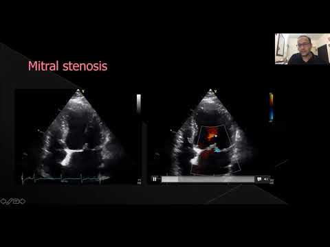 Philips Echo Webinar Series Mitral Stenosis Common Pitfalls in Echo Evaluation by Dr  Vinayak Agrawa