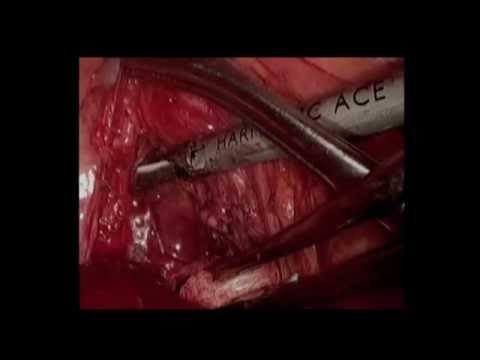 Torakoskopowa resekcja guza przytarczycy zlokalizowanego w śródpiersiu