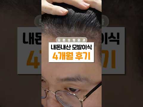 의사가 모발이식 받으면 생기는 일  | 정재홍 원장 4개월차 리얼토크
