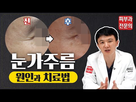 눈가주름도 다 같은 눈가 주름이 아니라고? 눈가 주름 원인별 치료방법!