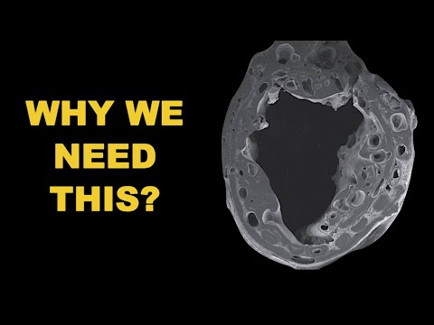 Peripheral Nerve regeneration with nerve conduits