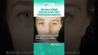 Waspadai Bibir Kering dan Pecah Bisa Jadi Tanda Penyakit Serius, Kenali Gejala dan Penyebabnya