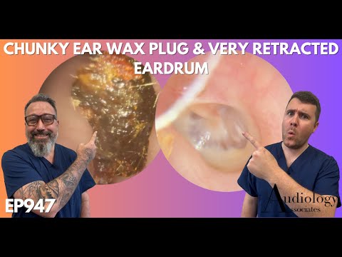 SHOCKED BY THE SIZE OF THIS EAR WAX PLUG - EP947