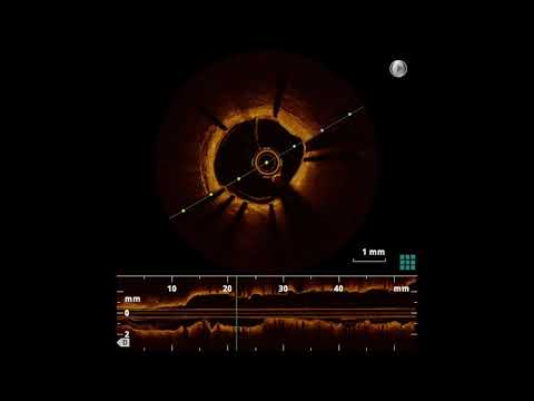Utility of OCT in Left Main stem PCI