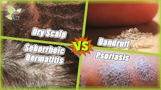 Dry Scalp -vs- Dandruff -vs- Seborrheic Dermatitis -vs- Psoriasis