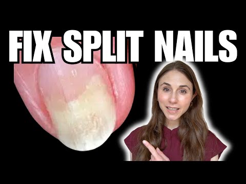 How To Fix Nail Splitting | Onycholysis