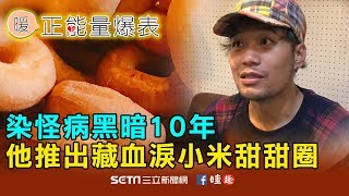 染怪病黑暗10年　他推出藏血淚小米甜甜圈