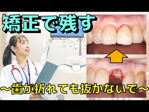 生命歯学科 【矯正で歯を残す】歯が折れてしまっても抜かないで！歯を抜かずに残す歯根挺出術（エクストリュージョン）をお教えします！治療の流れやメリットについて徹底解説していきます！