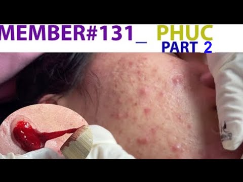 Acne Treatment Huong Da Nang# 131| MEMBER_ Phuc Part 2